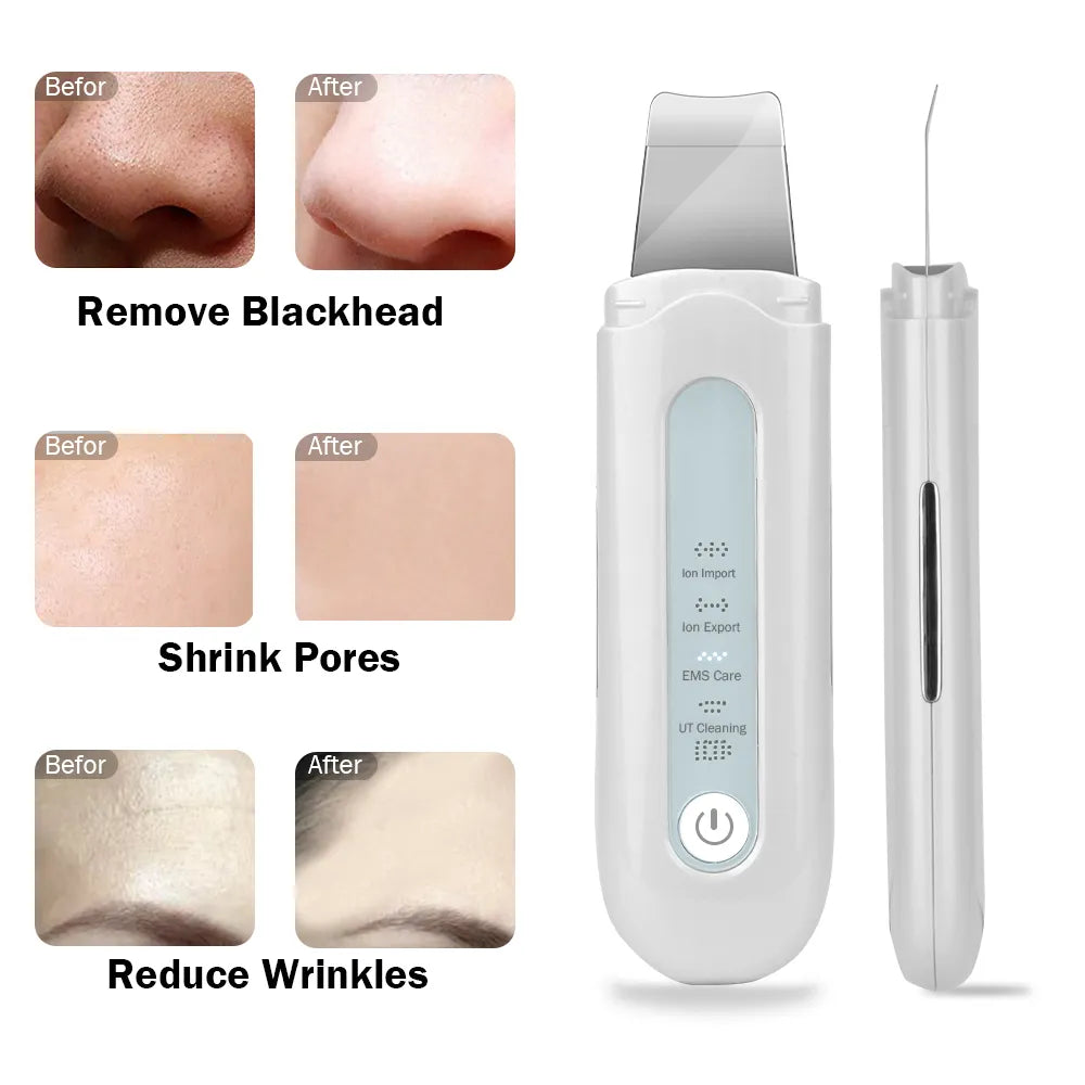 Ultrasonic Facial Scrubber - Yolee Glow