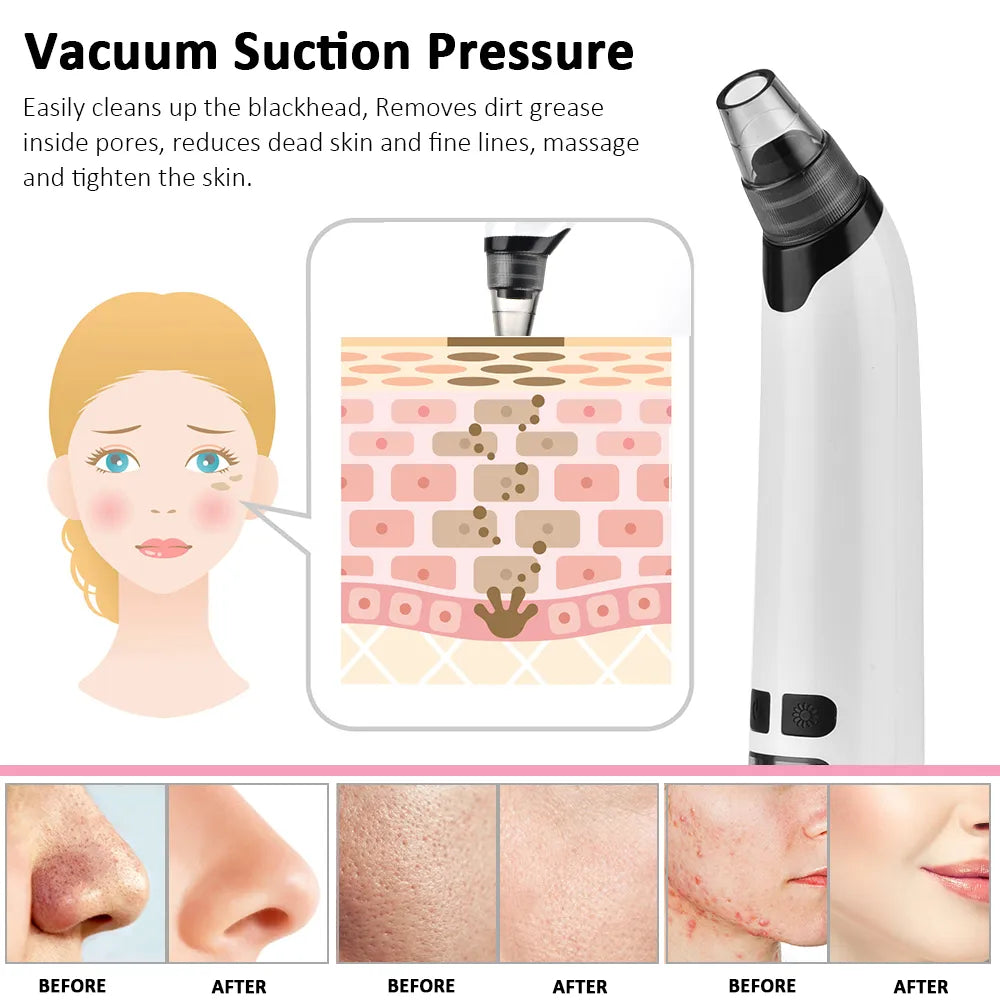 Electric Pore Cleaner Vacuum - Yolee Glow