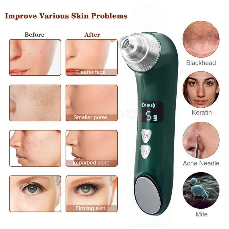 Heating Blackhead Suction - Yolee Glow