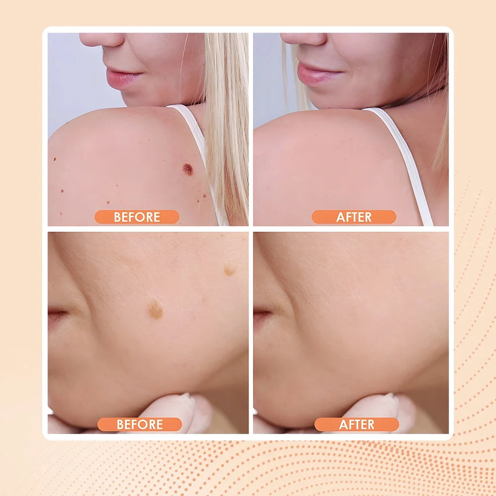 Laser Plasma Pen Tattoo Remover Skin Pore Care Corn Dark Tag Nevus Pimple Spot Cleaner Beauty Tools